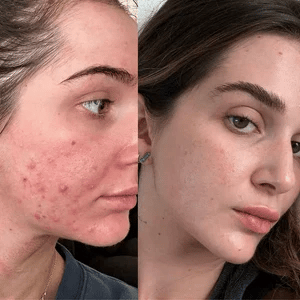 LED Face and Neck Therapy Massager